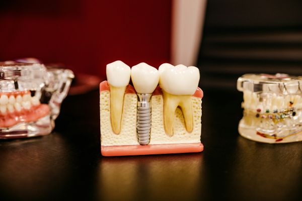 Implant dentaire : ce qu'il faut savoir avant de se lancer